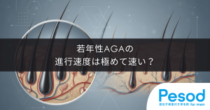 若年性AGAの進行速度は極めて速い？油断すると数年で進行するリスクの現実