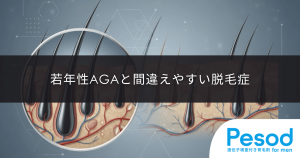 若年性AGAと間違えやすい脱毛症｜円形脱毛症や抜毛症との決定的な見分け方